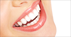 porcelain veneers