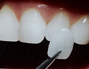 dental veneers