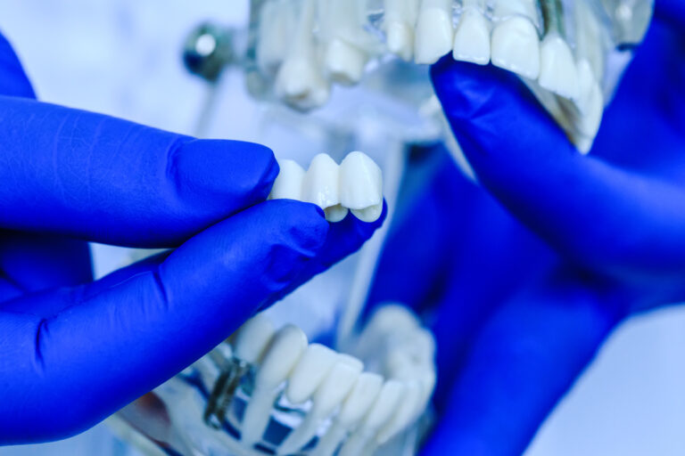 What Is A Dental Implant Bridge Long Island Cosmetic And Implant Dentists