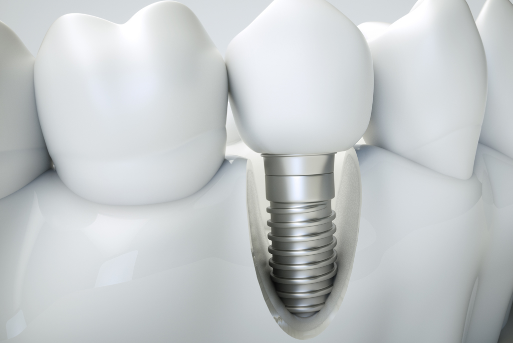 dental implants model