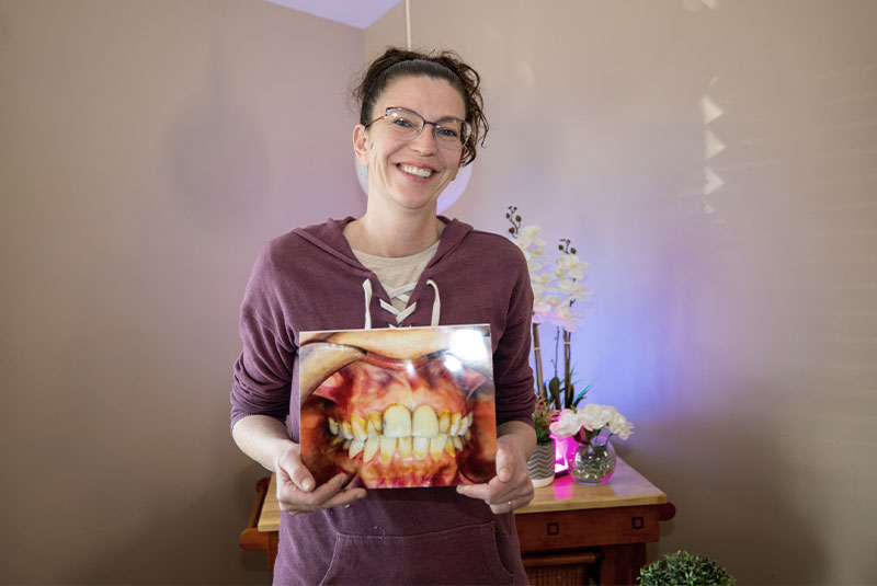 veneers patient smiling