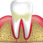 Gingivitis