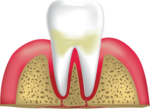 Gingivitis