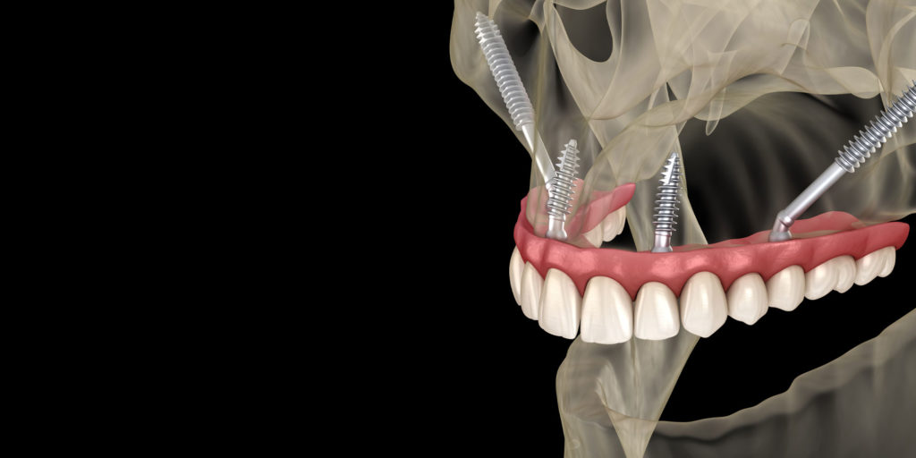 zygomatic dental implants graphic