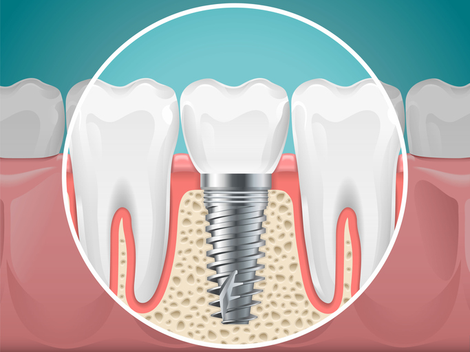 How Much Space Is Needed for a Dental Implant? Long Island Implant